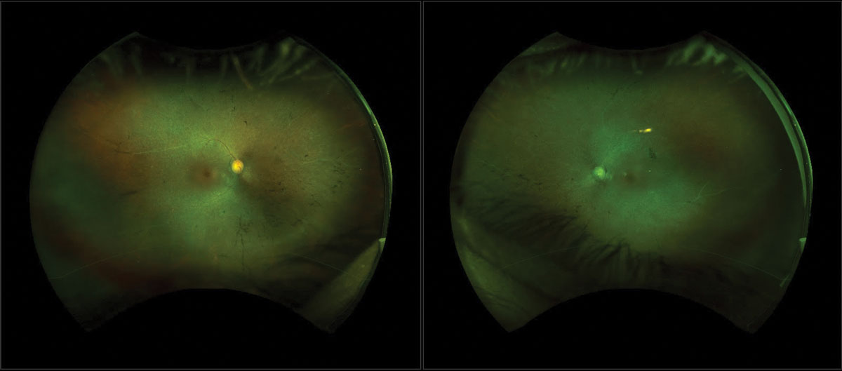 Fig. 1. FAF that displays a hyperfluorescent ring and hypopigmentation in the mid-periphery can be related to late-stage RP.