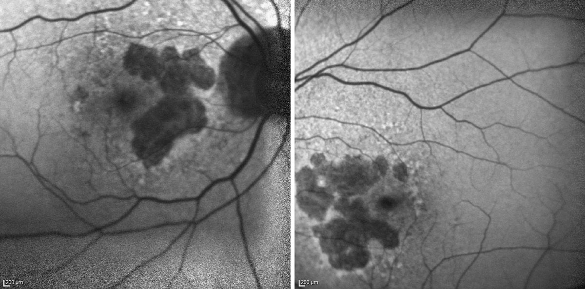 In this fundus autofluorescence image of geographic atrophy, you can see darkened regions of atrophy in both the patient’s eyes.