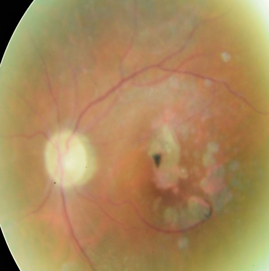 The fundus photo shows this patient in 2018.