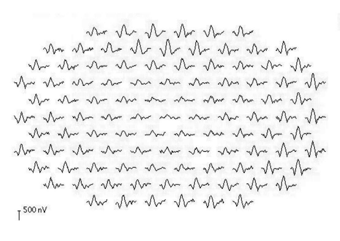 This mfERG shows a patient with central atrophy. Note the reduction in the size of the peaks for the central waveforms.