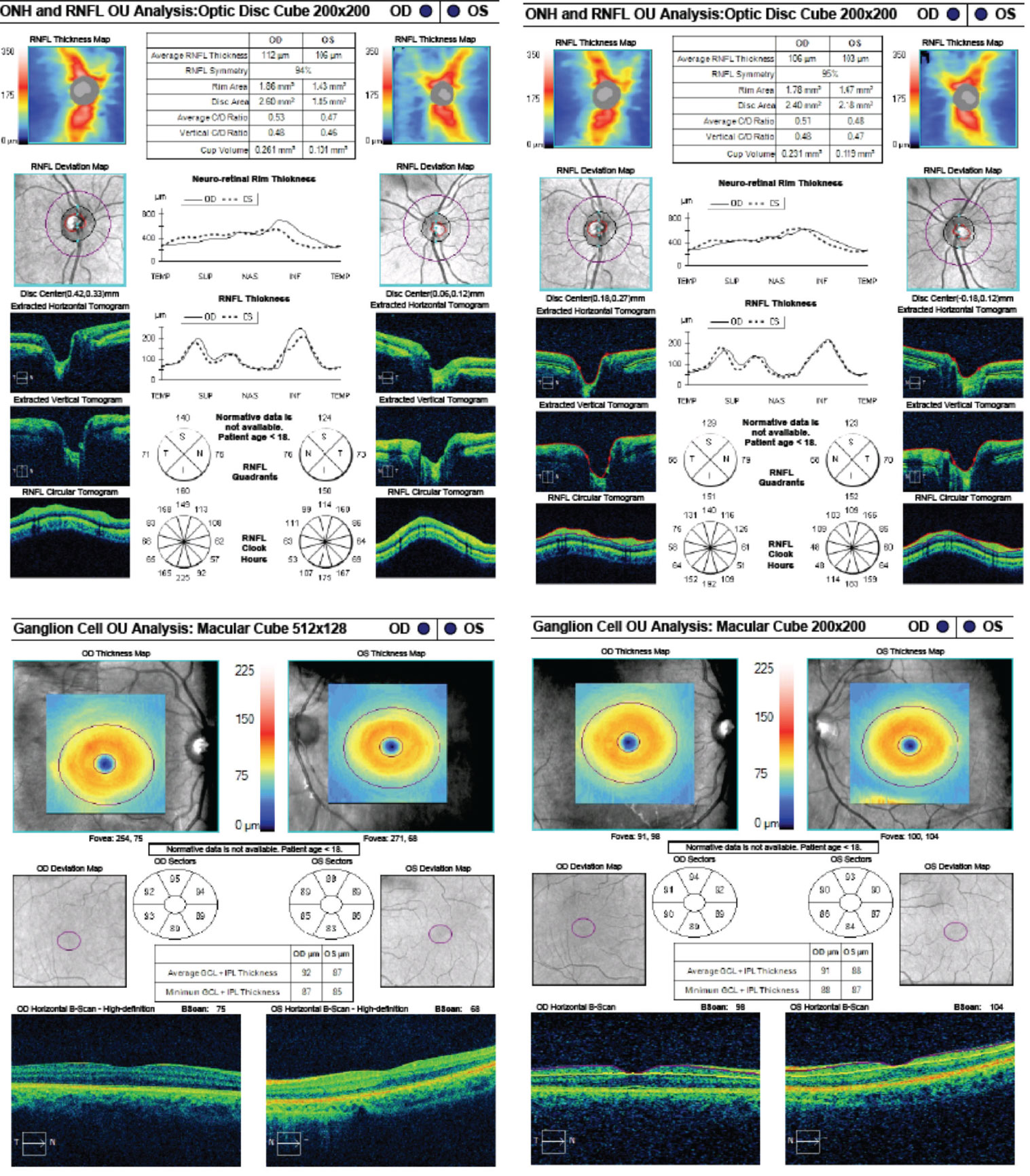 These are the patient’s OCT images upon initial exam, at left, and one year later, at right. The OCT demonstrates an intact RNFL and GCL in both eyes. Note the small disc area OS compared with OD, as well as gradual sloping of the temporal aspect of the cup OS compared with the symmetric margins of the cup OD.