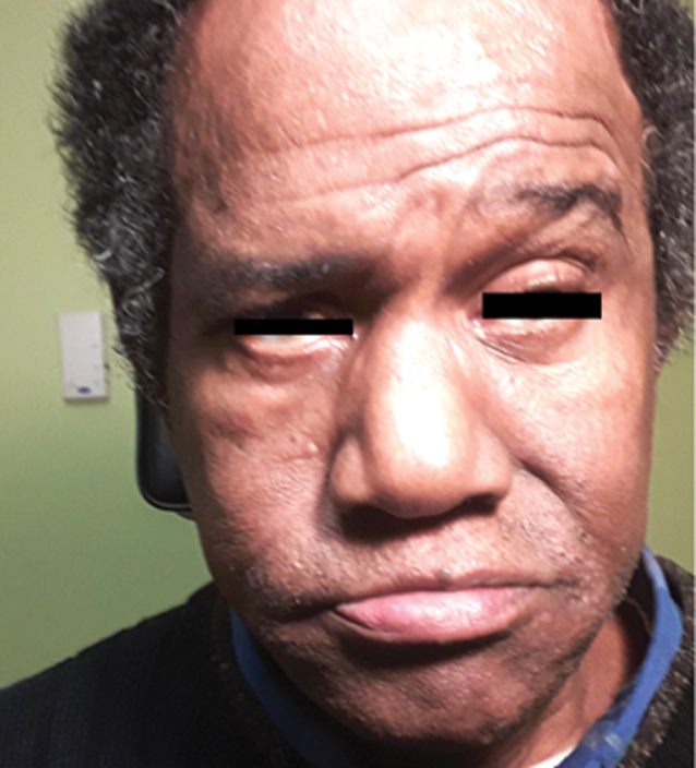 Fig. 1. The patient suffers from paralysis of the right side of the face in primary gaze.