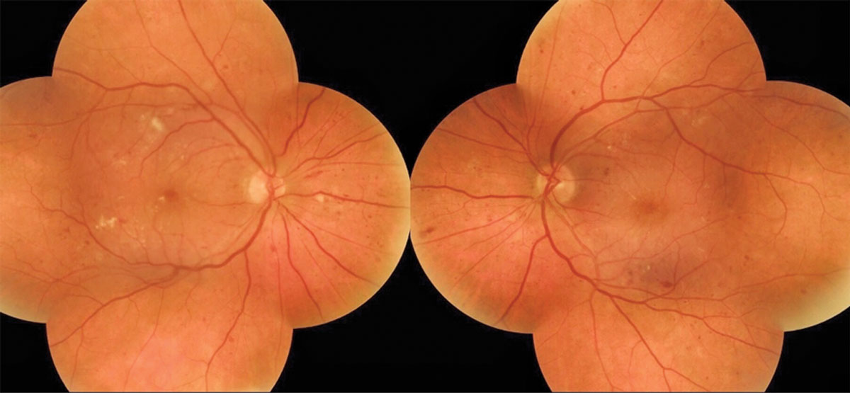 A 58-year-old female presented for her first eye exam without knowing she had type 2 diabetes and was found to have diabetic retinal changes OU.