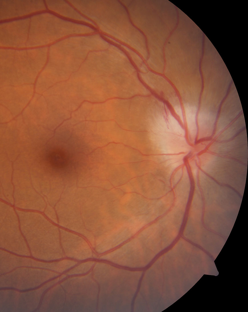 While not the case with this patient, an APD, decreased vision and pain on eye movement often accompany optic neuritis.  