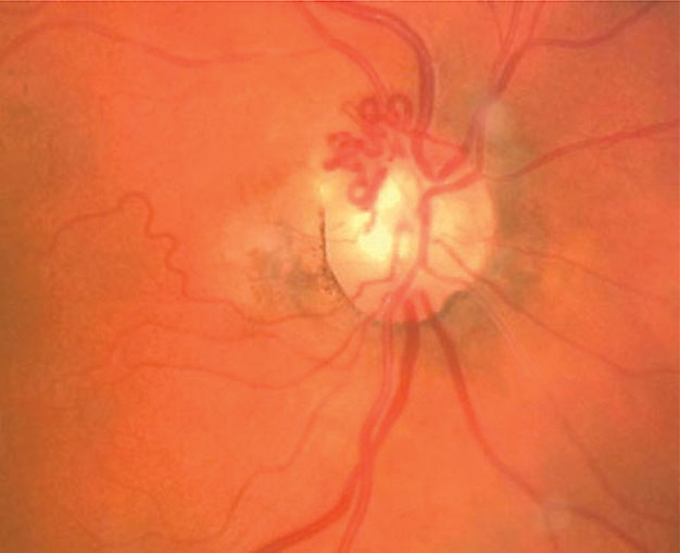 These collaterals formed over the optic disc in response to a CRVO.
