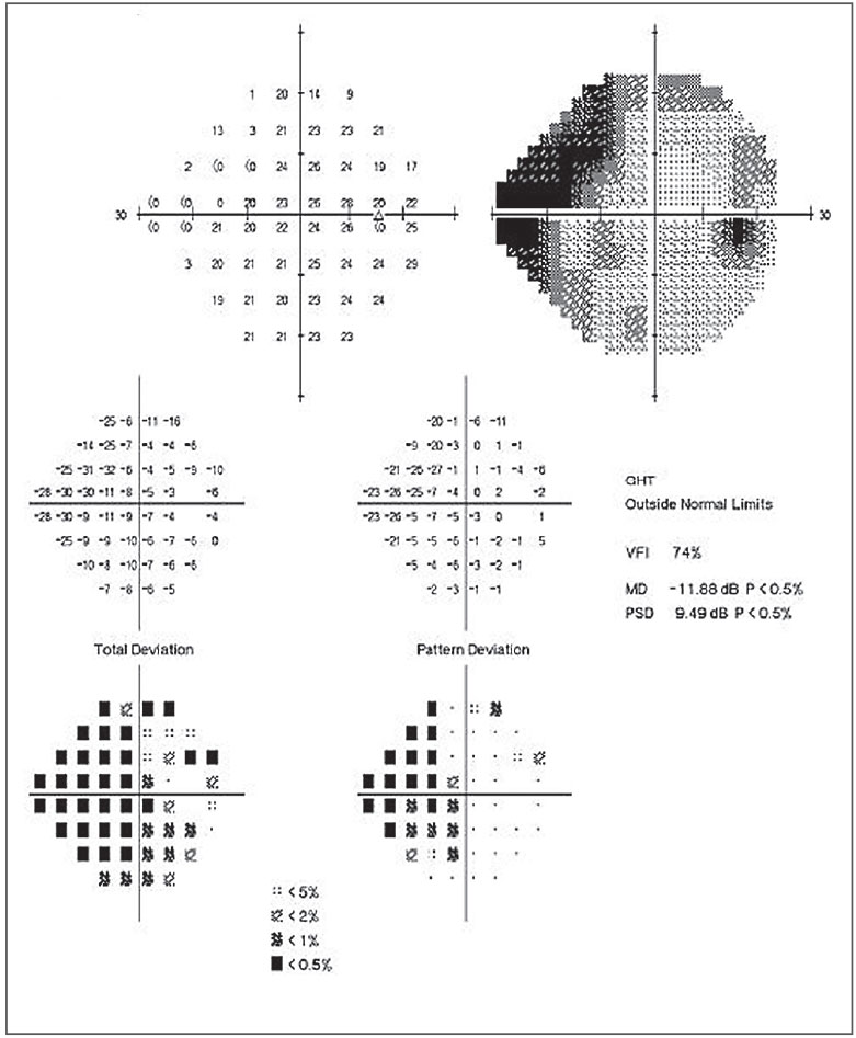 glaucoma vision loss pattern