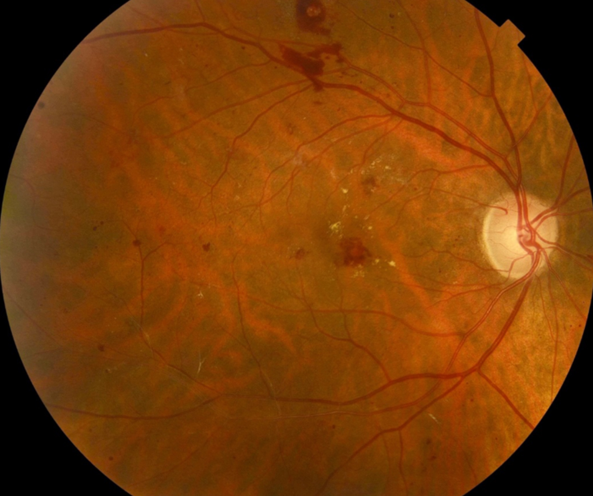 Diabetic patients, such as this one with moderate nonproliferative diabetic retinopathy, are commonplace in the optometry practice, and are more prone to hypoglycemic symptoms, especially those who need insulin to control their blood glucose.
