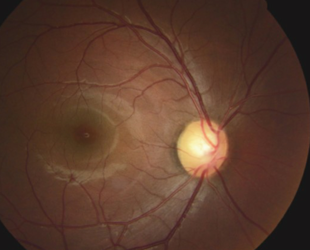 This fundus photo shows our 27-year-old patient’s right eye. He has a large, healthy optic nerve despite an intraocular pressure of 51mm Hg.