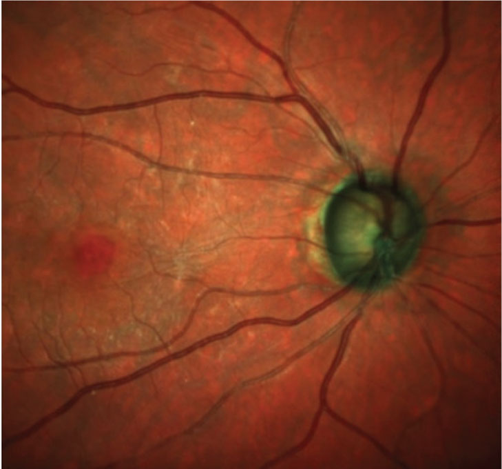 Fig. 1. Observe the thin neuroretinal rim and the ERM just nasal to the foveal avascular zone.