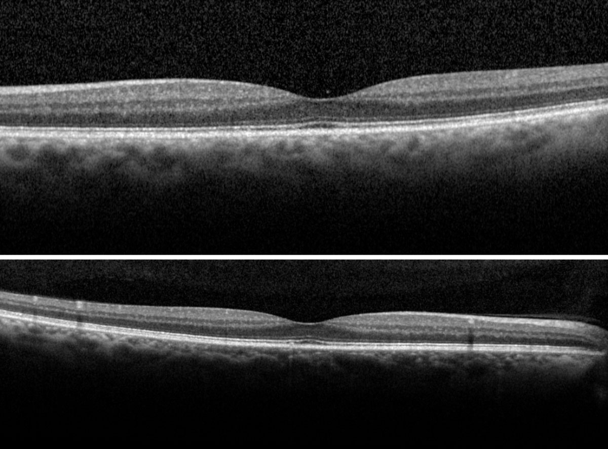 Fig. 4. The right (top) and left (bottom) macular scans show normal foveal contour without evidence of fluids. 