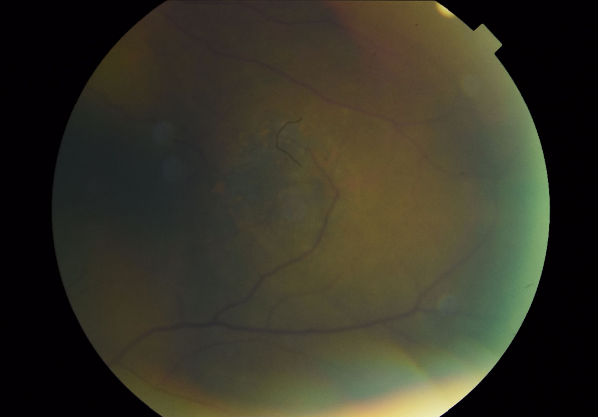 Fig. 7. A magnified fundus photo shows the dome-shaped lesion in the left eye temporal to the macula measuring 5- to 6-disc diameters. The presence of orange pigment spots, indistinct boarders, absence of drusen and halo can also be appreciated. 