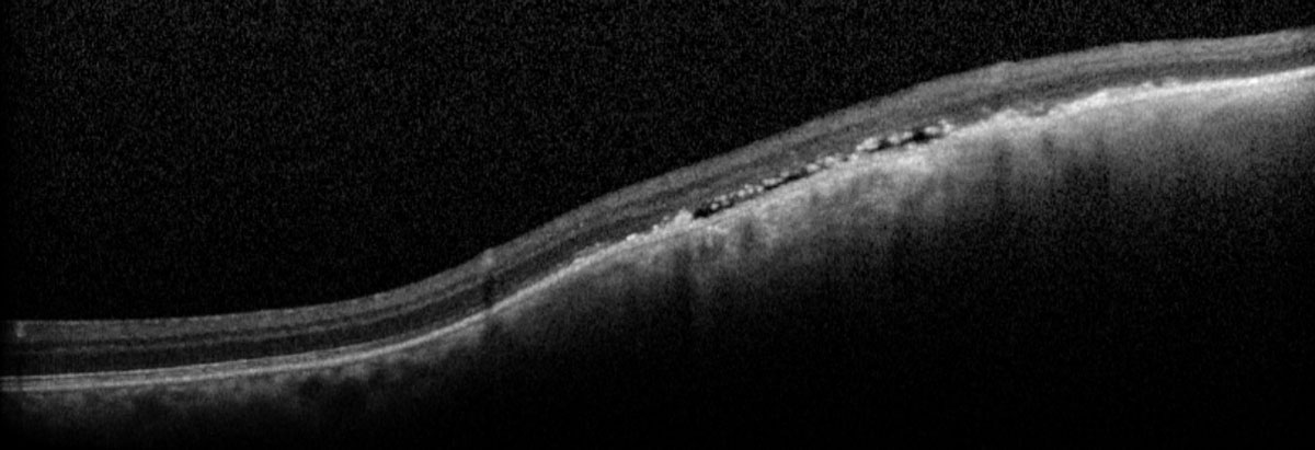Fig. 8. The macula OCT shows underlying subretinal fluid with elevation within the lesion. 