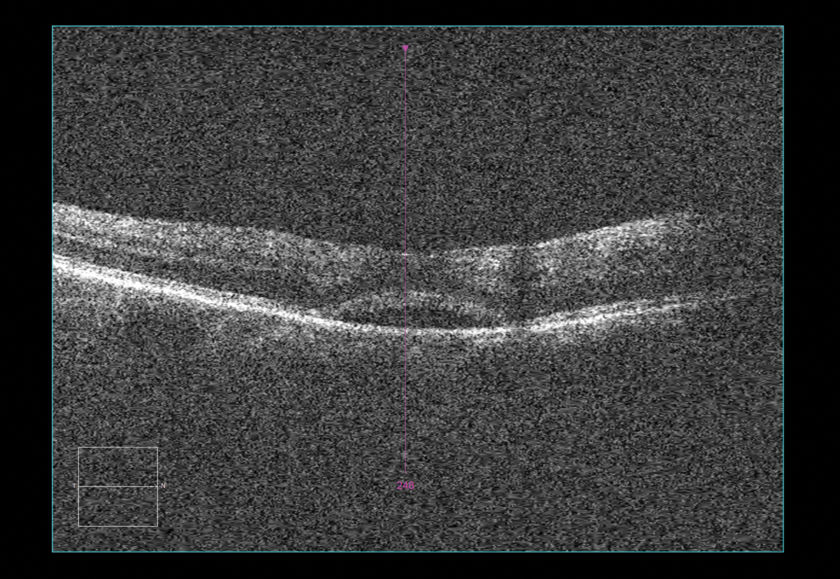 Interpretation and report of OCT performed in office two weeks after anti-VEGF injection: Clinical findings/diagnosis: H34.8310 tributary (branch)retinal vein occlusion, right eye, with macular edema. Reliability of the test: reliable OD. Comparative data/change in condition: improving OD. Clinical management: follow-up with retinal surgeon as scheduled in two weeks to consider repeating anti-VEGF intravitreal injection OD.