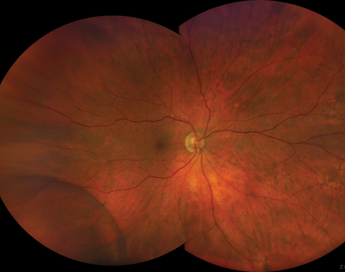 In most cases, a retinoschsis will neither impact vision nor carry any symptoms. However, on rare occasions, it can evolve into a retinal detachment. 