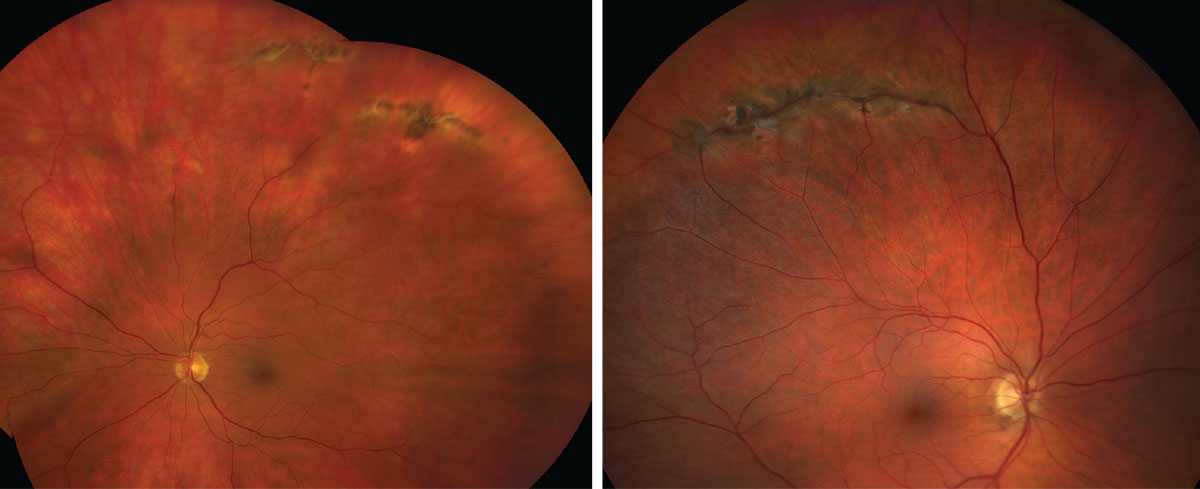 Lattice degeneration, as seen here, is associated with an increased risk of a retinal detachment.