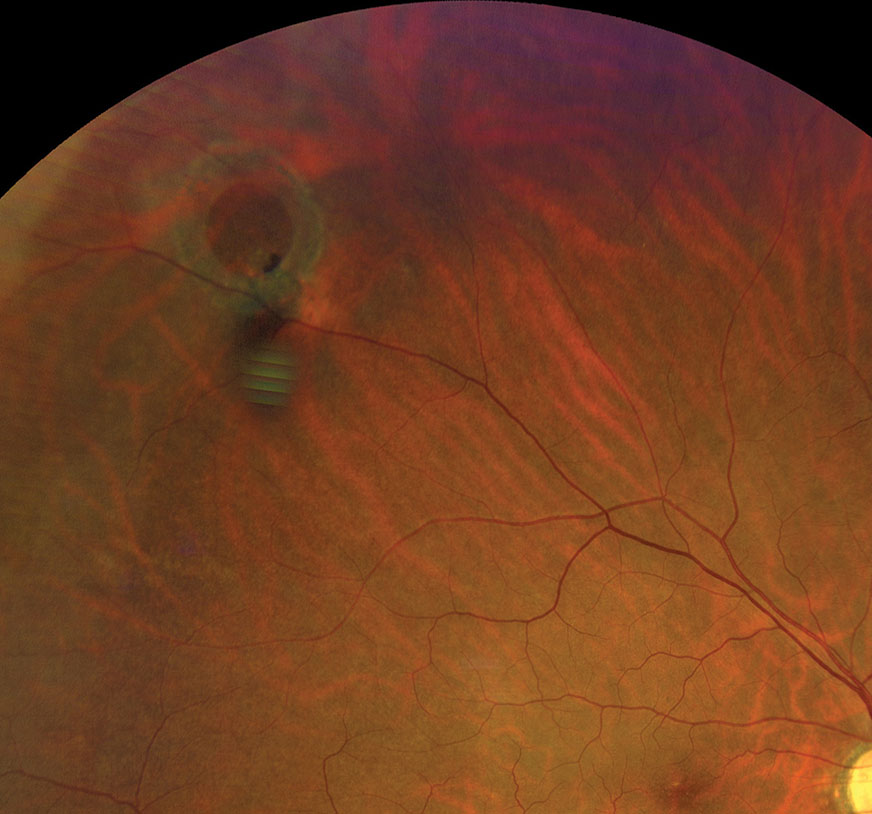 Refer operculated retinal hole patients with symptoms associated with RD to a retina specialist.
