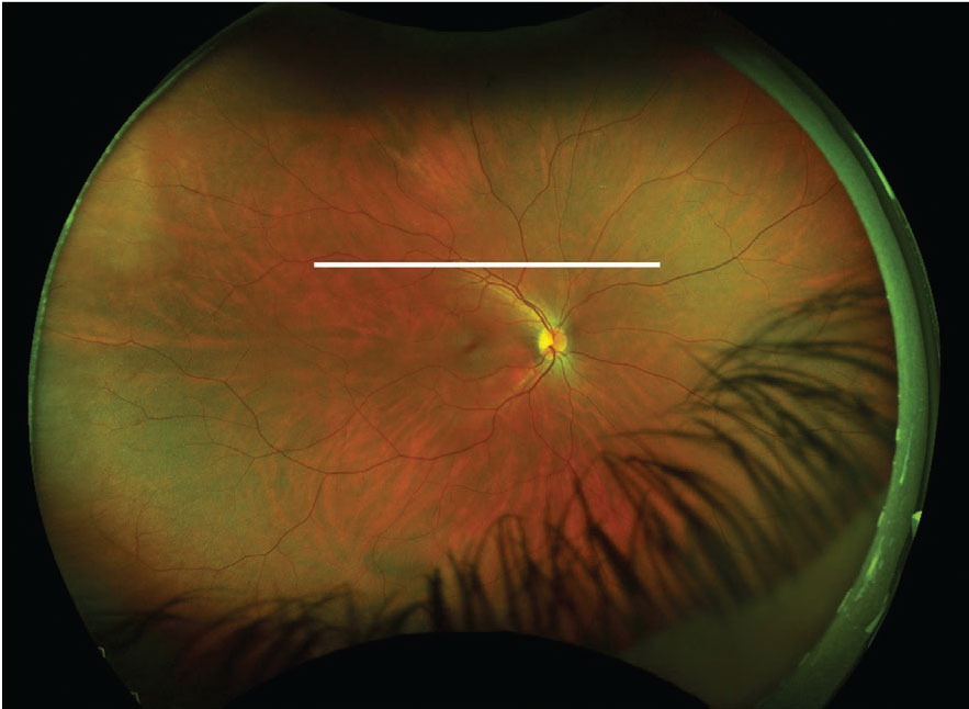 This fundus image has an ultrasound plane overlay for a T12 scan of the right eye (white line).