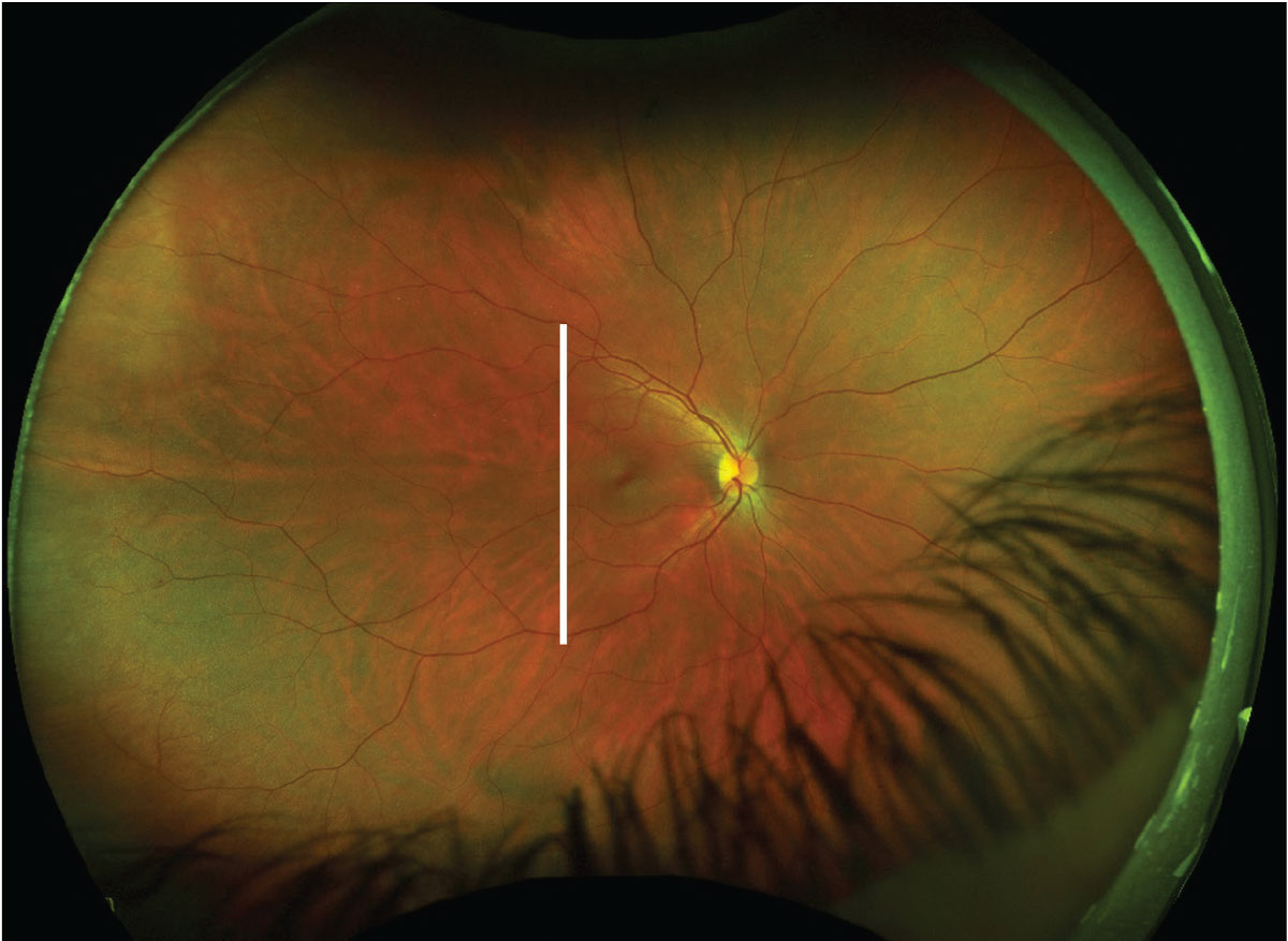 This fundus image includes an ultrasound plane overlay for a T9 scan of the right eye (white line).