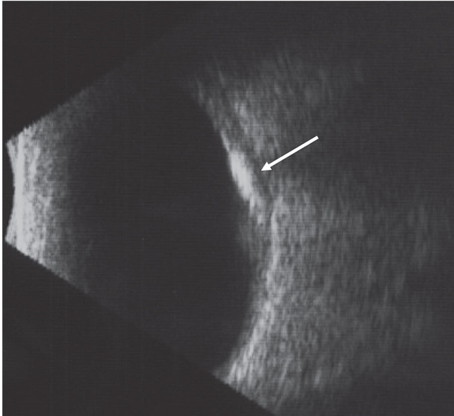 This B-scan image of choroidal osteoma highlights the high internal reflectivity of the lesion and the acoustic shadowing posterior to the lesion.