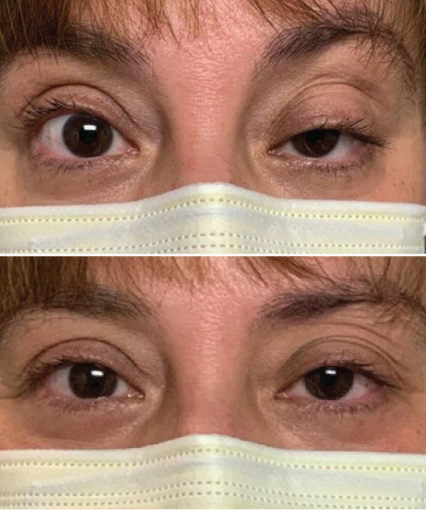 The ice pack test can help diagnose MG associated with lid ptosis.