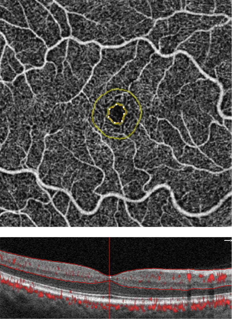 These are the FAZ metrics in a normal patient. Software analytics allow for an objective means of quantifying the FAZ and the surrounding area. The FAZ’s perimeter is outlined in yellow. Simultaneous visualization of the OCT angiogram alongside the structural B-scan provides optimal image interpretation.