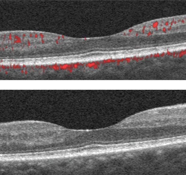 The SD-OCT B-scans show scattered hyper-reflective foci within the inner retina consistent with mild diabetic retinopathy.