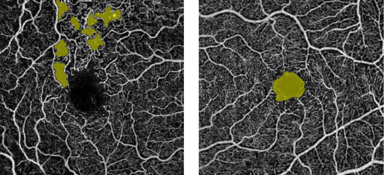 The “no-flow” tool measurement for a patient with diabetes allows for quantification of flow voids in pre-selected areas. The left panel shows scattered areas of non-perfusion highlighted in yellow; the right panel highlights the FAZ.