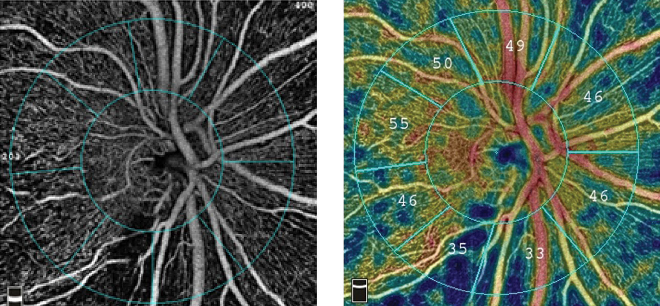 The radial peripapillary capillary angiogram, at left, and vessel density map, at right, show an inferior temporal wedge defect with reduced vessel density in a patient with primary open-angle glaucoma.