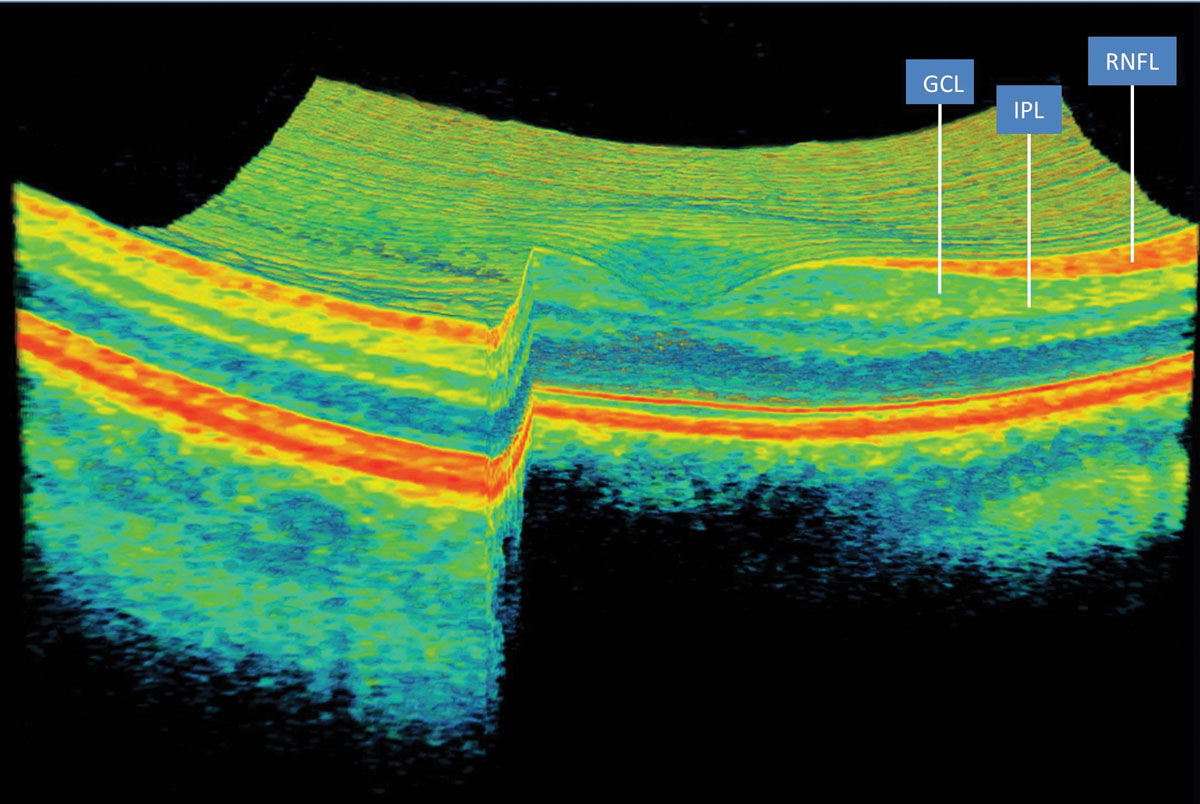 The DeepMind system can convert a raw OCT scan into a 3D-tissue map to aid treatment decisions.