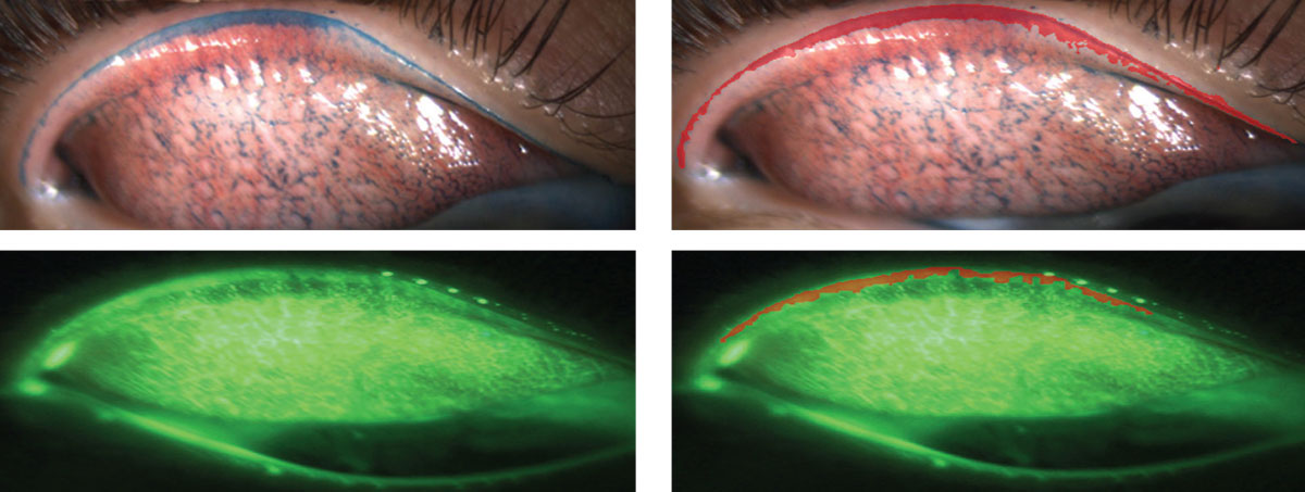 Fig. 1. All images are of everted upper lids. Images on the left use lissamine green and sodium fluorescein, respectively. See the areas colored in red on the right that outline what is considered to be lid wiper epitheliopathy.  