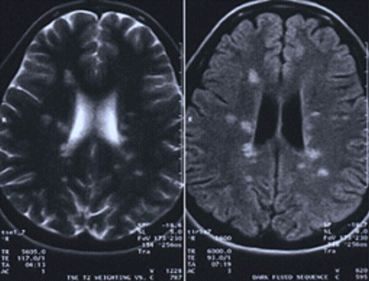 This MRI with and without contrast is positive for MS, showing a lesion located around the ventricles and juxtacortical and in the temporal lobe.