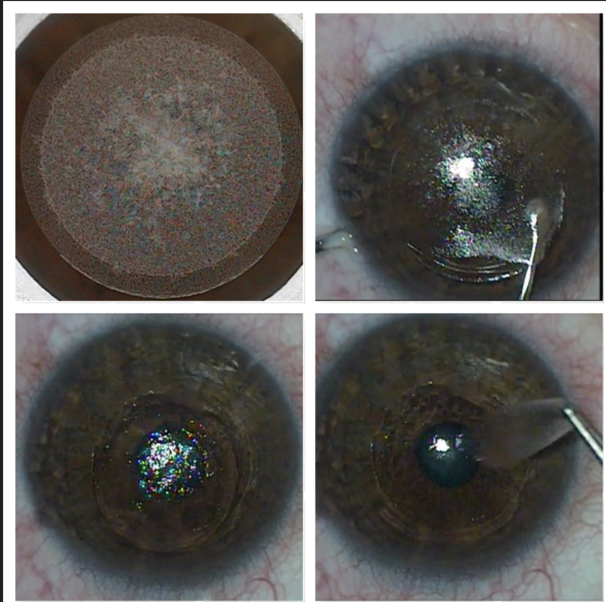 The SMILE procedure creates (top left), dissects (top right) and removes a lenticule (bottom left and right) to correct myopia and myopic astigmatism.
