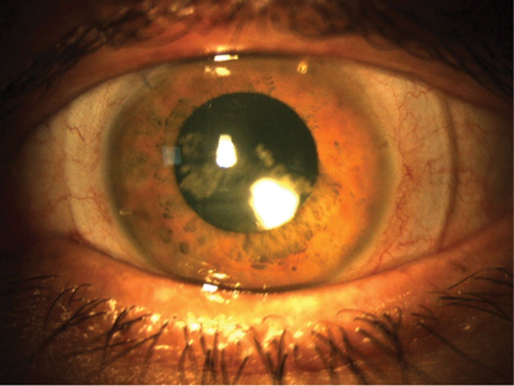 A scleral lens with too much tear exchange can cause debris to collect in the bowl (seen centrally) and reduce the patient’s visual acuity.