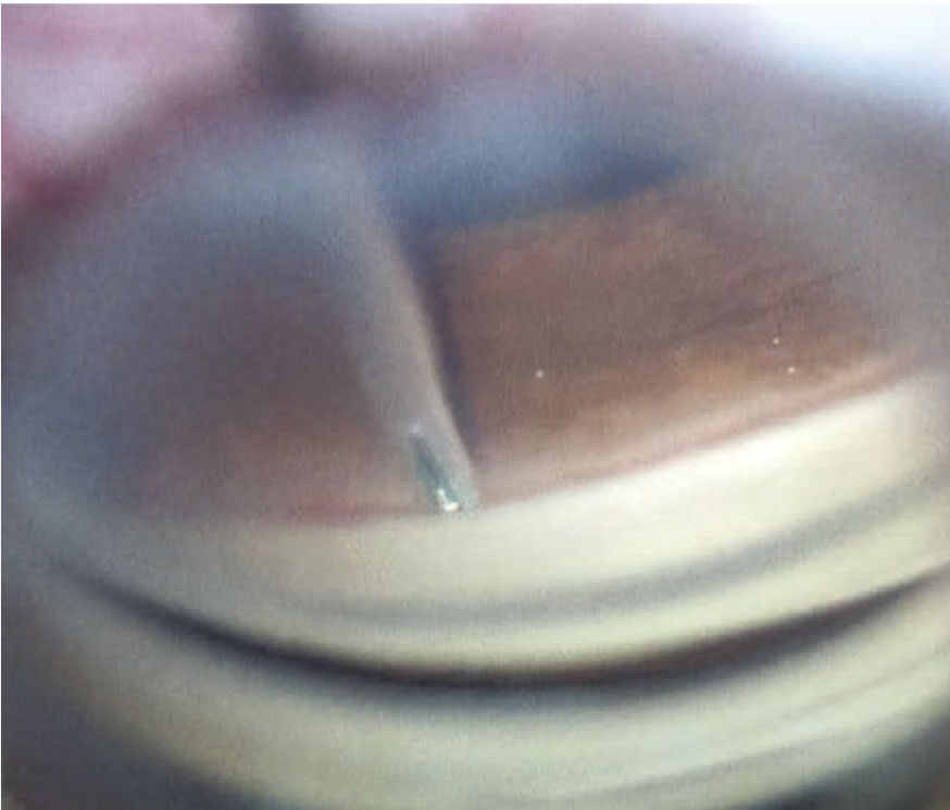 iStent inject insertion directly following cataract surgery. 