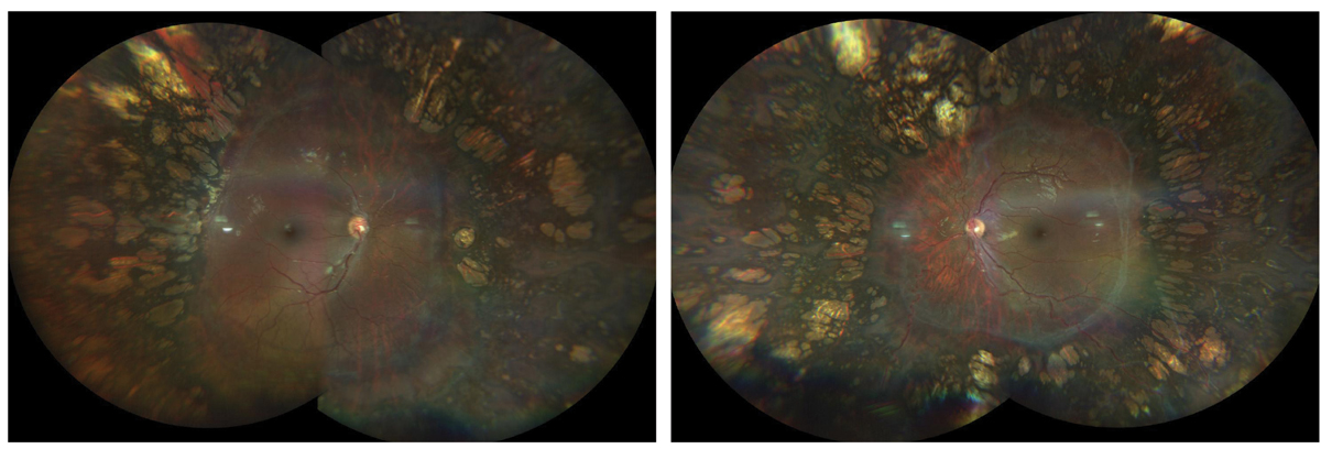 The photos above show the right fundus (left image) and left fundus (right image) of our patient. What might cause such a presentation?