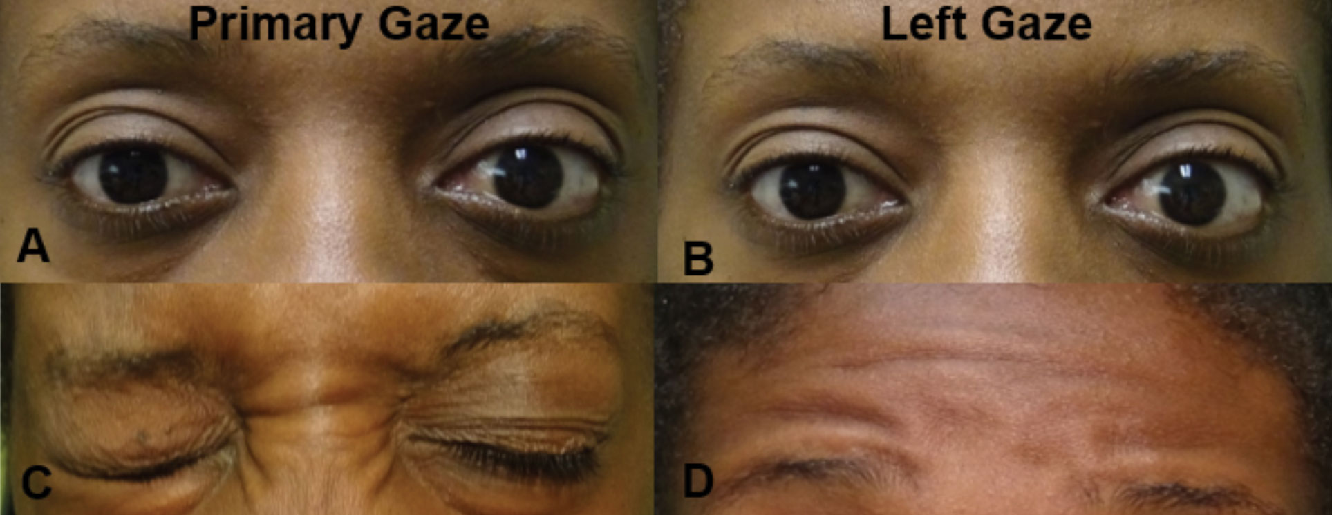 In primary gaze (A), there is a noted difference in palpebral apertures due to the left lower lid lagophthalmos. In left gaze (B), there is no movement of either eye consistent with a left gaze palsy (likely at the left CN VI nucleus). There was associated left orbicularis oculi weakness (C) and left frontalis weakness (D), both consistent with a partial left CN VII lesion. The combination of these findings localizes the lesion to the left pons involving both the CN VI nucleus and CN VII fasiculus.