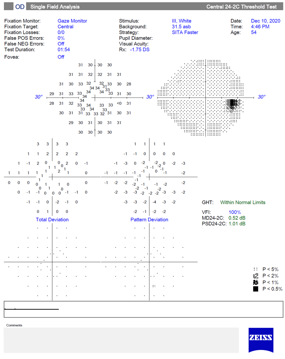 These are VFs performed over 10-year-period in a patient with pseudoexfoliation glaucoma. Event-based analysis shows a message of “likely progression” due to multiple points worsening in the inferior nasal quadrant on 3+ consecutive visits. Although event-based analysis clearly shows the development of an inferior partial arcuate defect, trend analysis shows that the rate of change is actually quite slow.