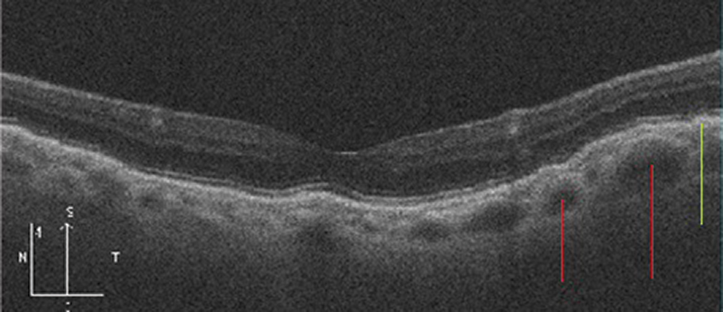 Fig. 2. Pachychoroid epitheliopathy. Note the larger choroidal vessels (red lines) causing choroidal thickening and inner- shifting of the RPE, and associated epitheliopathy (green line).