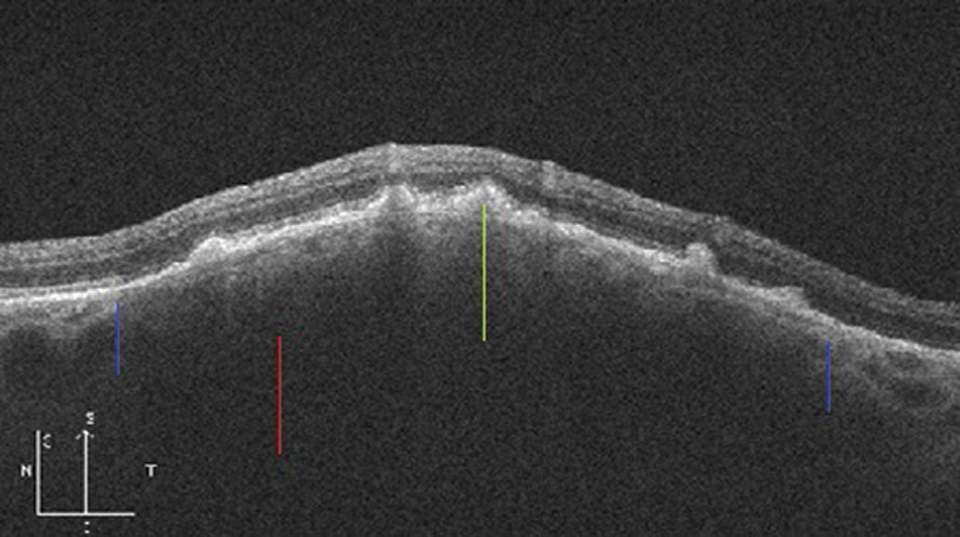 Fig. 3. Thickened choroidal nevus with posterior shadowing (red line) and overlying drusen (green line). The blue lines indicate the approximate inferior and superior margins of the nevus.