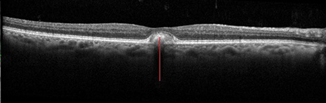 Fig. 8. Lipofuscin accumulation (red line) within and anterior to the RPE, here in adult-onset vitelliform macular dystrophy. 