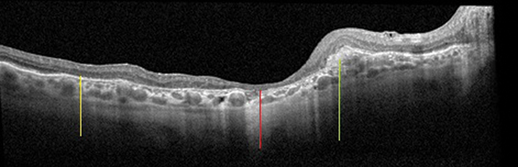Fig. 10. A patient with previous exudative macular degeneration, now with subretinal fibrosis (green line) and atrophy. Areas where atrophy becomes very apparent are outer retinal atrophy (yellow line) and RPE/outer retinal/intraretinal atrophy (red line).