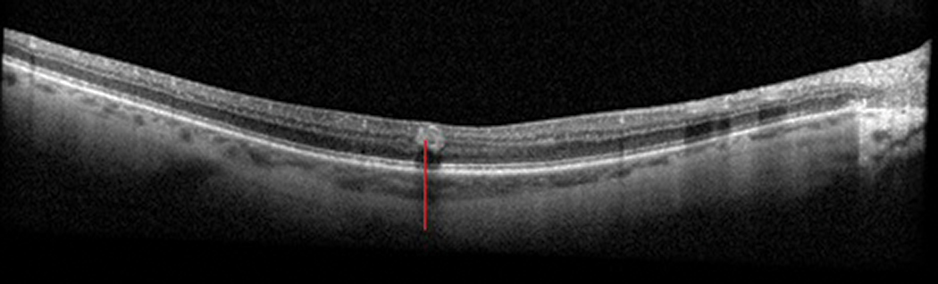 Fig. 14. An intraretinal hemorrhage (red line) seen in a patient with diabetic retinopathy.