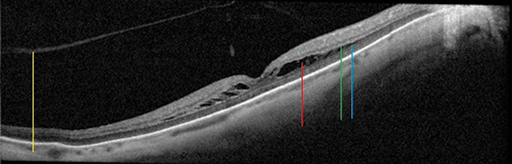 Fig. 15. Foveoschisis cavity (red line) separating the outer plexiform (green line) and outer nuclear (blue line) layers in this myopic patient, who also has a generally thin choroid. The posterior hyaloid of the vitreous (yellow line) is detached.