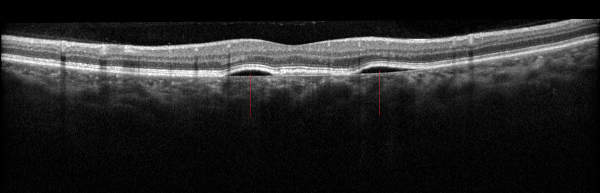 Multifocal serous PEDs in the macula, where serous fluid appears dark posterior to/under the RPE (red lines).