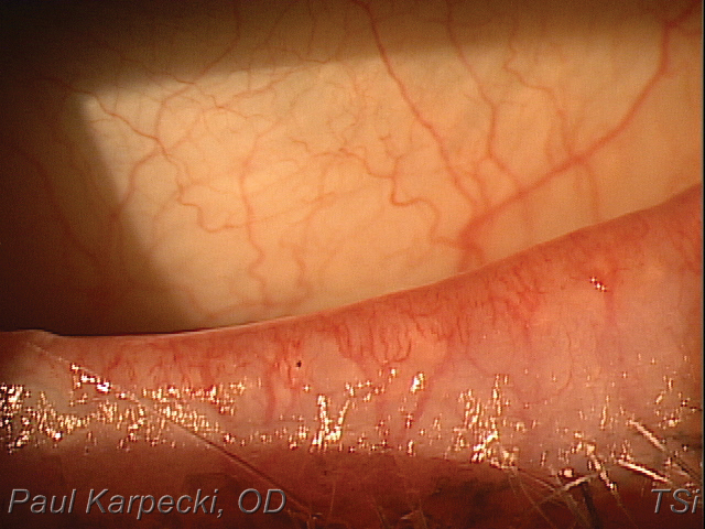 Telangiectasia with ocular rosacea may be responsive to treatment with combined IPL/LLLT.