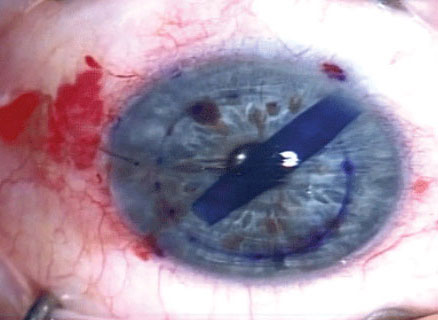 During DMEK, donor Descemet’s membrane tissue is stained with trypan blue for better visualization of the eye. 
