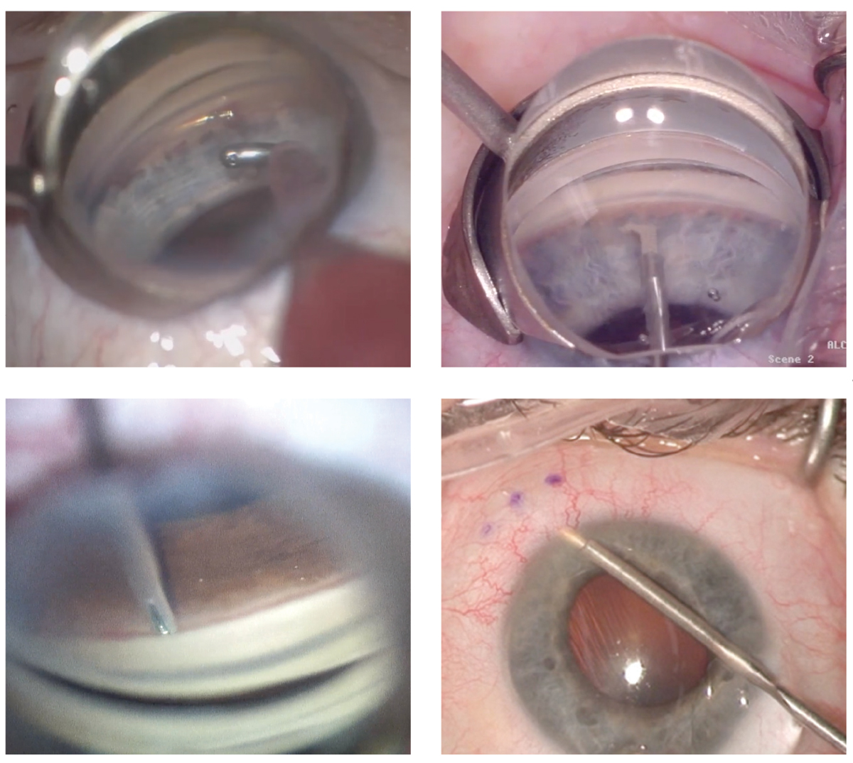 The development of minimally invasive glaucoma surgeries for use at the time of cataract surgery has increased the capabilities of surgeons—and the expectations placed on comanaging optometrists, who need to be able to sort out the many proceudres and make well-informed recommendations to the ophthalmologist. Clockwise from upper left: Hydrus Microstent (Ivantis), Kahook Dual Blade (New World Medical), Xen implant (Allergan), iStent (Glaukos).