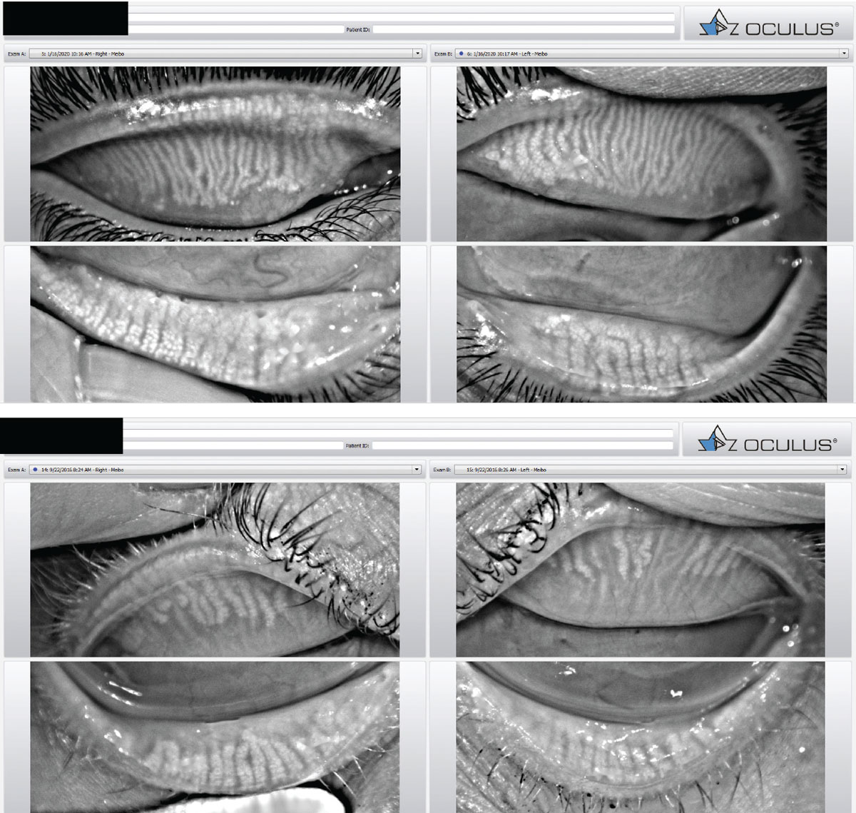 Meibography images taken with the Oculus Keratograph. Healthy glands are columnar and relatively straight (top). Meibomian gland atrophy associated with MGD (bottom).