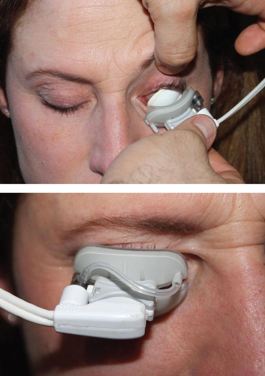 LipiFlow uses a combination of heat and lid massage to liquefy meibum and clear obstructed meibomian glands.