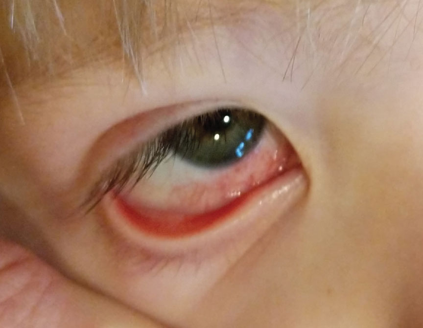 Fig. 2. Sectored red-eye presentation in a three-year-old.  All pediatric red eyes, especially unusual presentations, should have a full vaccine history included in the work-up.